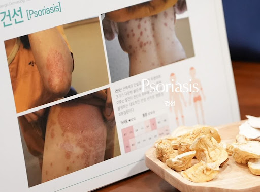 생기한의원으로 살펴보는 건선 증상 지속 시 의료기관 상담 흐름